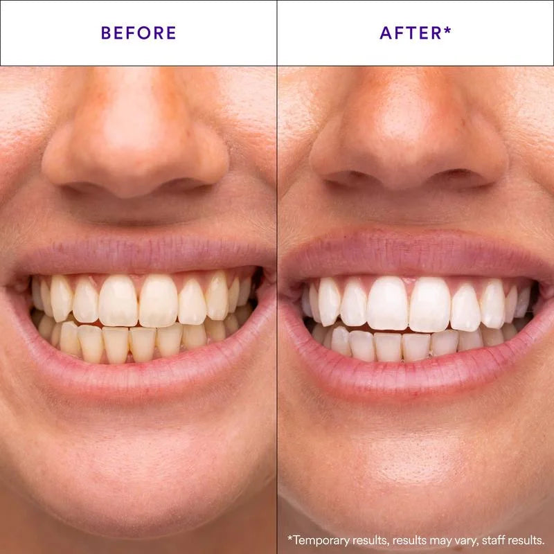 Purple Teeth Whitening Strips – Removes Yellow Stains, Instant Bright Smile