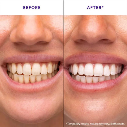 Purple Teeth Whitening Strips – Removes Yellow Stains, Instant Bright Smile